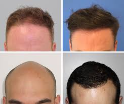 The UK's Best Hair Transplant Surgeons at The Private Clinic