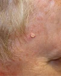 Look out for any new, changing or unusual skin growths, so you can spot skin cancers like bcc when they are easiest to treat and cure. Aging Us Population Drives Brisk Increase In Merkel Cell Carcinoma The Dermatologist