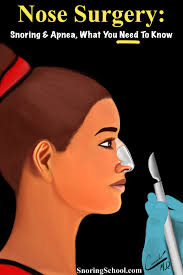Nose Surgery Snoring And Apnea What You Need To Know Nose Surgery Sinus Surgery Cure For Sleep Apnea