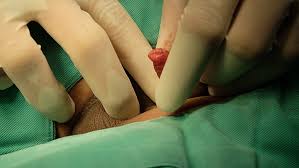 Image result for Phimosis