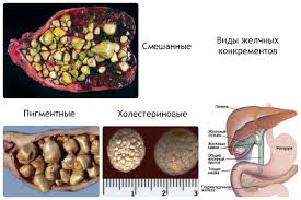 Prichiny Simptomy I Metody Lecheniya Kamnej V Zhelchnom Puzyre