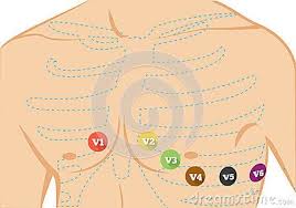 Chest Ecg Leads Placement Illustration Six Colored Electrocardiography Leads Illustration Color Ekg Leads