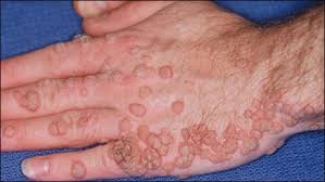 Image result for human papillomavirus symptoms