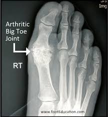 Maybe you would like to learn more about one of these? Disorders Of The Great Toe Orthopaedia