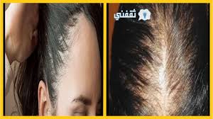 تكثيف الشعر من الأمام في أسبوع بسرعة فائقة بمكونات طبيعية ثقفني رشاقة وجمال