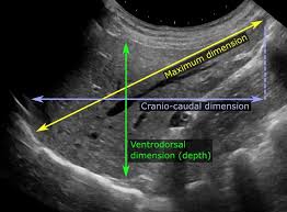 Abdominal Ultrasonography Of The Liver As A Sagittal Plane Through The Midclavicular Li Medical Ultrasound Diagnostic Medical Sonography Ultrasound Sonography