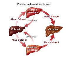 Cet organe roi (le plus volumineux du corps) pâtit souvent d'un manque d'attention. Maladies Alcooliques Du Foie Liste Et Symptomes D Alerte