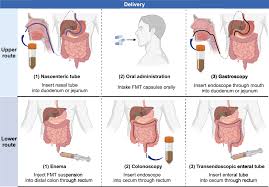 Image result for Fecal Transfer