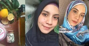 I know it, it is like chalk solution. Wanita Ini Kongsi Caranya Hilangkan Parut Jerawat Dengan Cepat Hanya Guna Masker Bedak Baby Hijabista