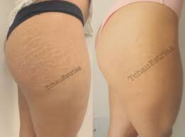 A Brazilian Tattoo Artist Is Making Stretch Marks Disappear With Ink The Independent The Independent
