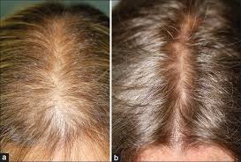 Supports hair health & strength. Microneedling For Hair Loss Md Needle Pen