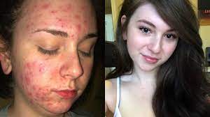 Acne And Iuds Allure