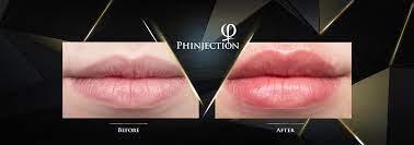 Each attendee will be required to demonstrate their proficiency in performing these techniques after receiving extensive hands on training with live patients. Phinjection Phiacademy