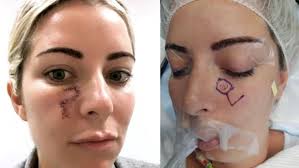 The techniques he uses will depend upon the amount of skin … Does Skin Cancer Removal Have To Leave An Ugly Scar