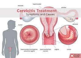 Image result for Acute Cervicitis