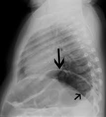 When to use the ap lordotic view of the chest? Interpretation Of Chest Radiographs In Infants With Cough And Fever Radiology
