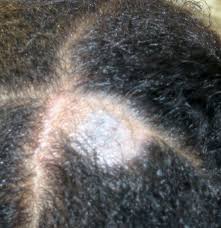 Image result for white scabs on the head in children