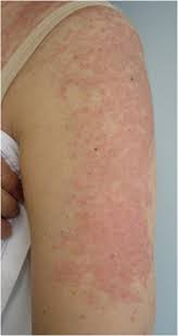 Widespread rash on the this rash appears on the nose and cheeks in the shape of a butterfly, skipping the skin under each. Cutaneous Lupus Erythematosus A Review Of The Literature Sciencedirect