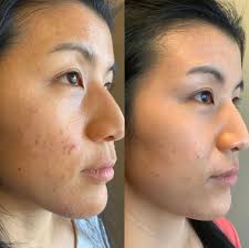 Eliminate Acne And Get Clear Skin With Light Therapy And Acupuncture Road To Wellness Los Gatos Acupuncture