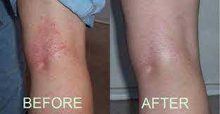 Cryotherapy For Eczema And Psoriasis Cryospa Iowa