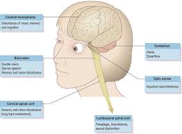 Numbness or weakness in one or more limbs that typically occurs on one side of your body at a time, or your legs and trunk Multiple Sclerosis Neupsy Key