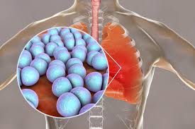 Signs of infection include redness, swelling, or yellow discharge where the iv is inserted; Pneumocoque Premiers Symptomes Transmission Et Traitements