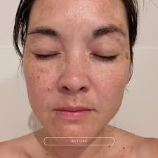 As I approached 40, dark spots and redness became some of my biggest  concerns. I started noticing them more, especially after pregnancy.  Hormonal changes, like melasma, caused dark patches to appear seemingly