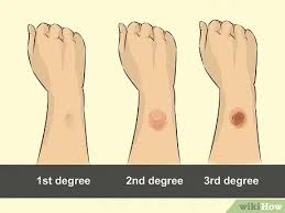 Verbrennungen Mit Aloe Vera Behandeln 9 Schritte Mit Bildern Wikihow