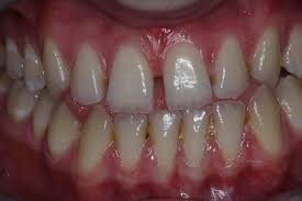 May 26, 2020 · keep in mind the following: White Fillings Before And After Photos Front Tooth Composite Fillings