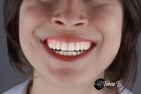 Şeffaf Plak Tedavisi, Invisalign Tedavisi İzmir