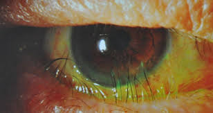 Image result for Entropion