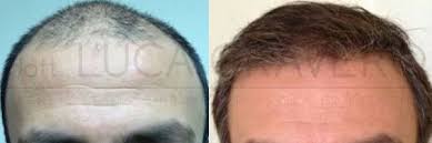 Ecco le informazioni necessarie per procedere. Autotrapianto Di Capelli Fut Fue Evitare La Calvizie