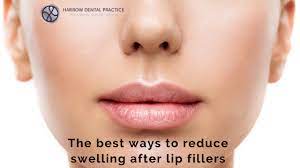 There's a curve of how big the lip looks after surgery. The Best Ways To Reduce Swelling After Lip Fillers Harrow Dental Practice Blog