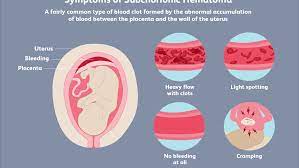 Vaginal bleeding or spotting during the first trimester of pregnancy is relatively common. Subchorionic Hematoma And Pregnancy Risks