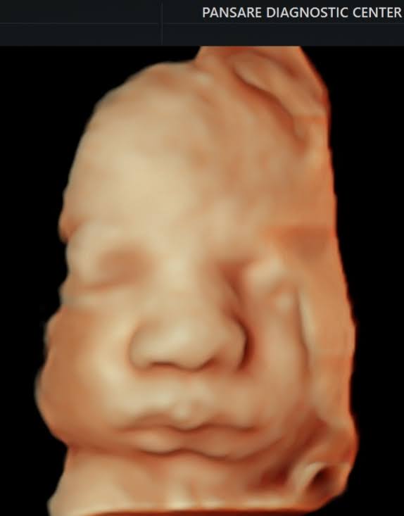 Sonography