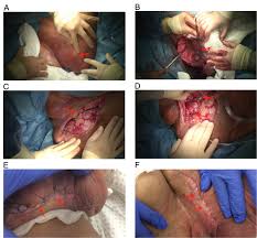 A short history of fournier gangrene, «arch dermatol». Cureus Fournier S Gangrene Under Sodium Glucose Cotransporter 2 Inhibitor Therapy As A Life Threatening Adverse Event A Case Report And Review Of The Literature