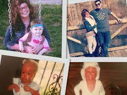 This limits the body's movement, including ability to breathe proteus or wiedemann syndrome, causes an overgrowth of bone, skin, and other tissues, in proportion to the rest of the body. I M The First Mom With Harlequin Ichthyosis Stephanie Turner Essay