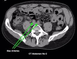 Image result for CT Intravenous Contrast