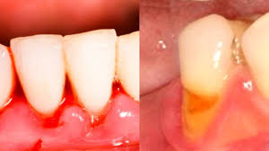 How and ways to prevent it? What Snus Can Do To Your Gums Dipping Oral Cancer Youtube