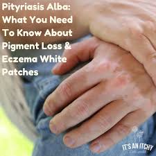 We did not find results for: Pityriasis Alba What You Need To Know About Pigment Loss Eczema White Patches