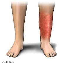 Image result for Cellulitis