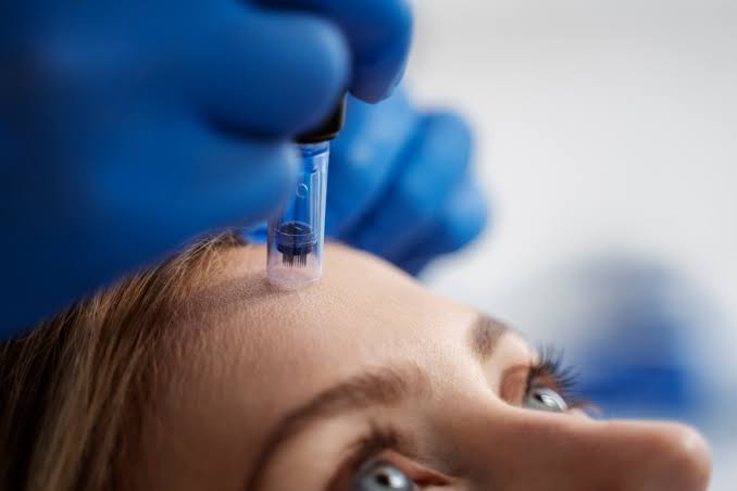 What is Skinpen Microneedling in Altrincham? - Dermanude Skin Clinic