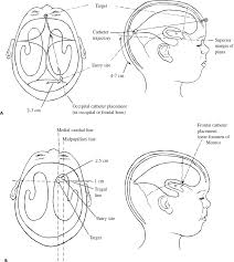Cerebrospinal Fluid Shunts Neupsy Key