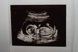 Ssw 14 Ultrschallbild Fetus 13 Ssw Ultraschall 14 Ssw 14 Wochen Schwanger