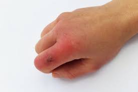 Image result for Chilblains