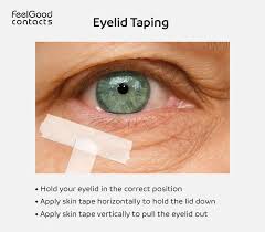 Image result for Entropion