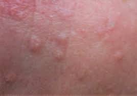 In one small study it is important to note that due to its acidic nature, apple cider vinegar alone may cause skin irritation. Creating Flawless Skin