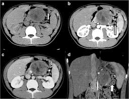 Those guy's are talented and smart. Abdominal Ct Scans Of Symptomatic Spt In A 21 Year Old Woman A Download Scientific Diagram