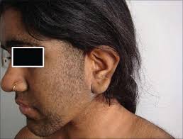 Image result for Hypertrichosis
