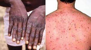 Monkeypox, viral disease of both animals and humans that causes symptoms similar to those of smallpox, though less severe. Monkeypox Outbreak In The Uk Two Treated For Rare Viral Infection In North Wales World News Wionews Com